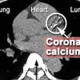 Coronary Artery Calcium Scoring