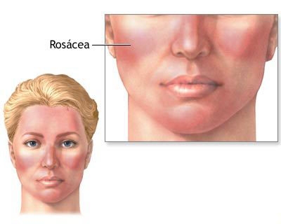 Rosacea diagnosis and treatment