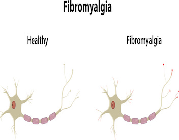 Fibromyalgia Doctor - specialist GP with extensive experience of Fibromyalgia