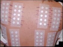 Patch Test for contact dermatitis - Typical battery